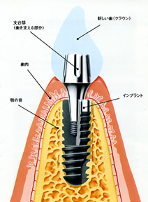 インプラント