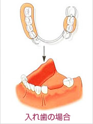 入れ歯