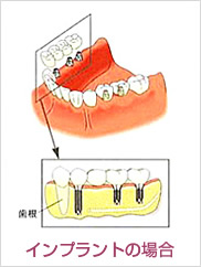 インプラント